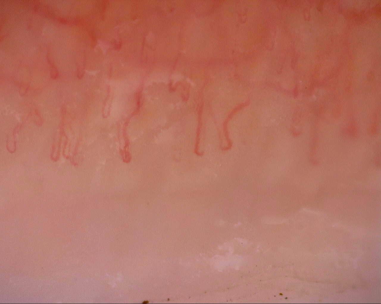 Nailfold capillaroscopy: right little finger, field c. Initial study. Mixed Connective Tissue Disease Presenting with Raynaud Phenomenon.