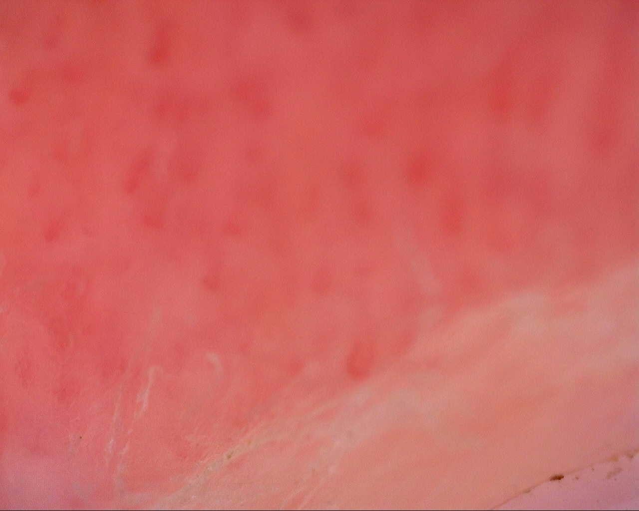 Nailfold capillaroscopy: left little finger, field c. Initial study. Mixed Connective Tissue Disease Presenting with Raynaud Phenomenon.