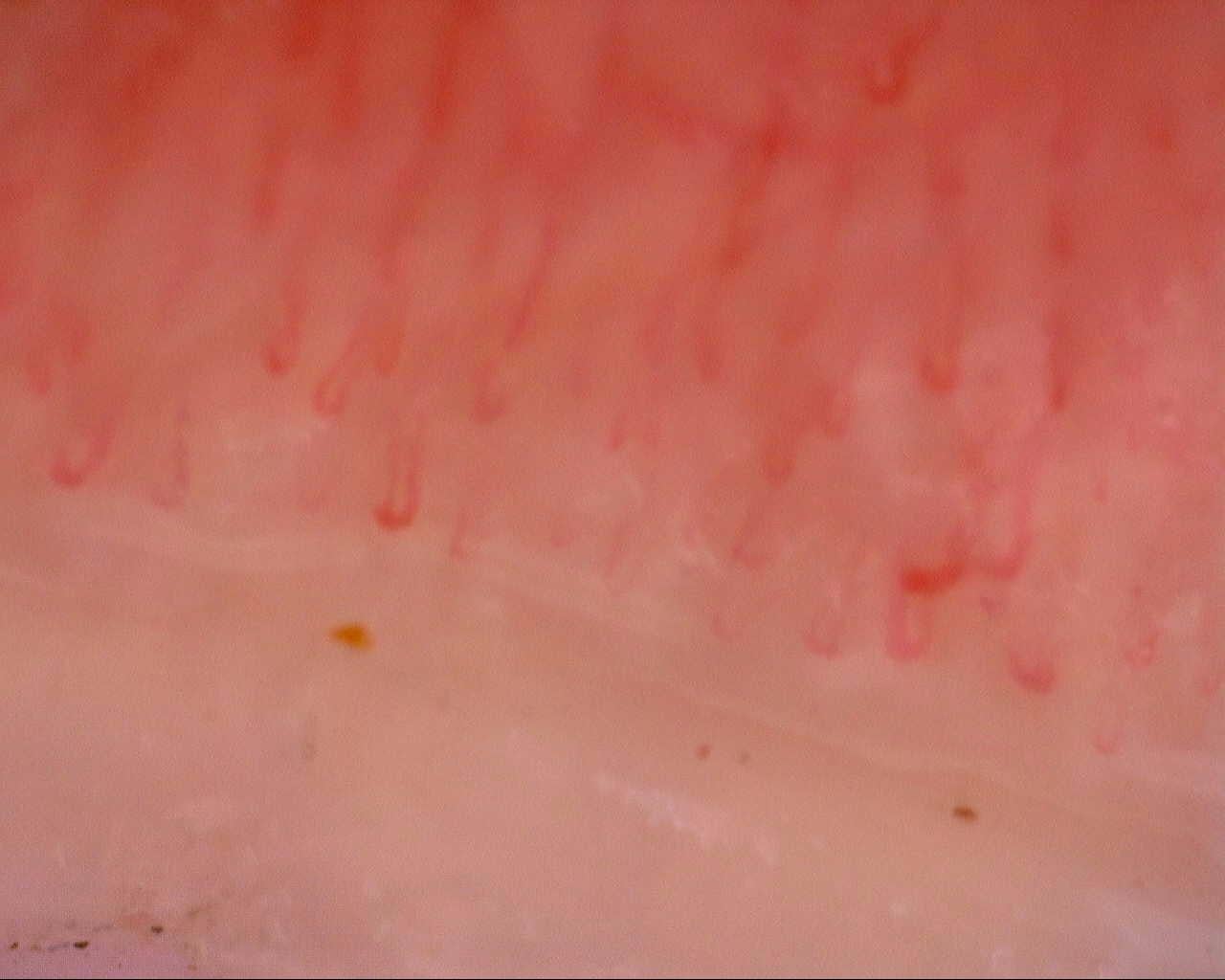 Nailfold capillaroscopy: right middle finger, field d. Initial study. Mixed Connective Tissue Disease Presenting with Raynaud Phenomenon.