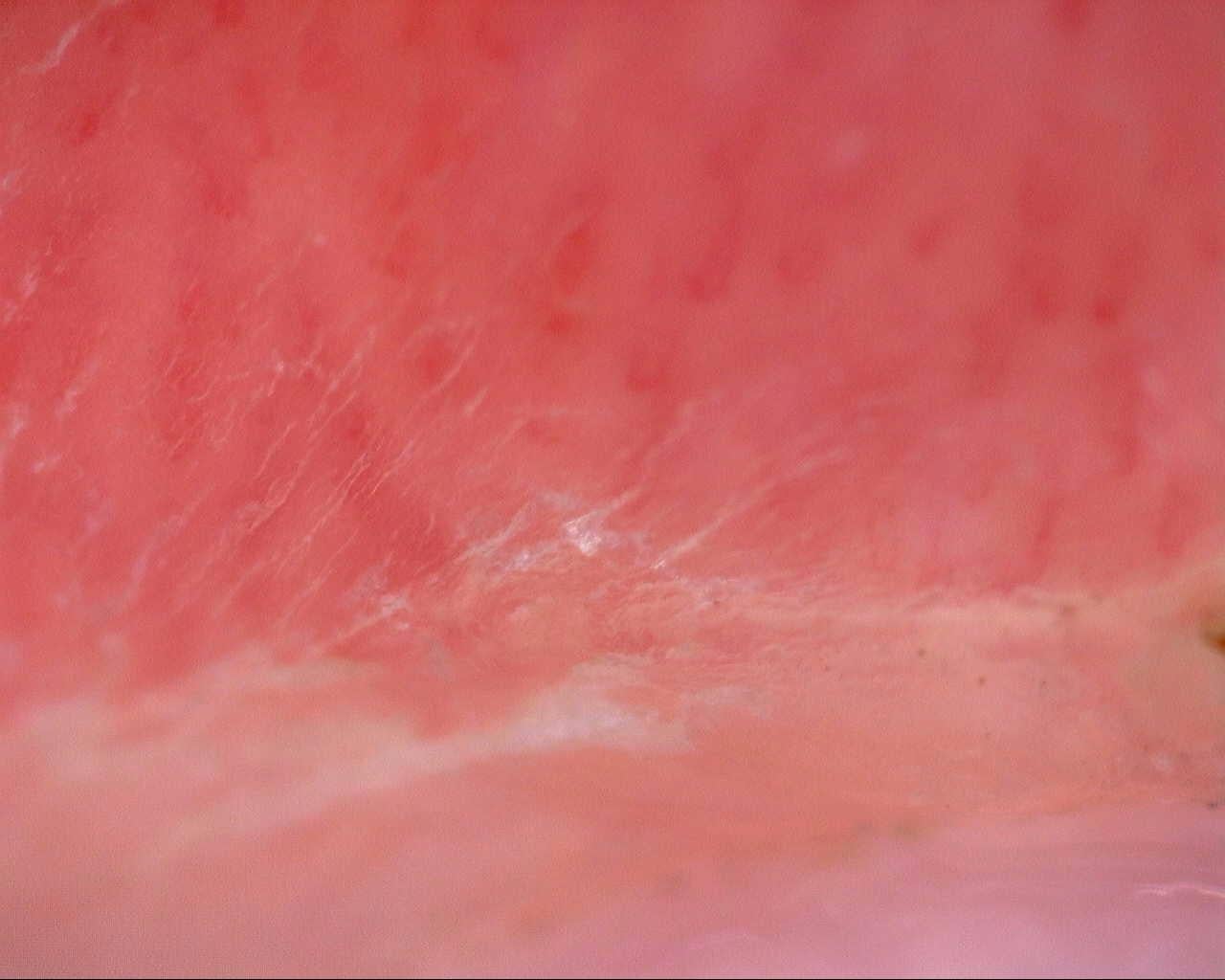 Nailfold capillaroscopy: left little finger, field b. Initial study. Mixed Connective Tissue Disease Presenting with Raynaud Phenomenon.