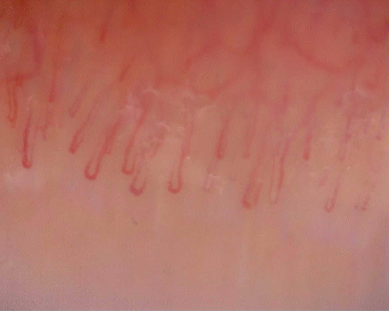 Nailfold capillaroscopy: right ring finger, field c. Initial study. Mixed Connective Tissue Disease Presenting with Raynaud Phenomenon.
