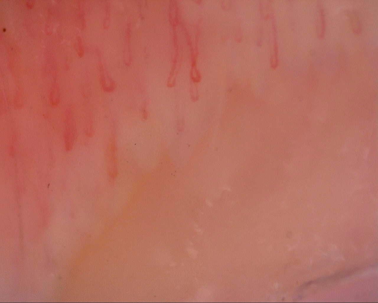 Nailfold capillaroscopy: left ring finger, field d. Initial study. Mixed Connective Tissue Disease Presenting with Raynaud Phenomenon.