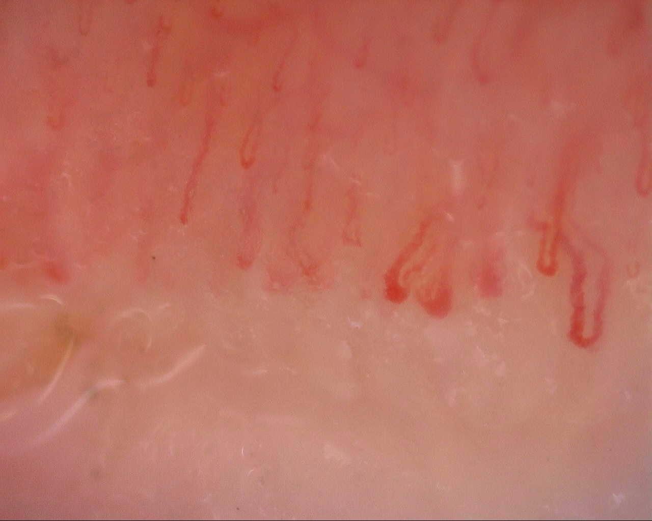 Nailfold capillaroscopy: right ring finger, field a. Initial study. Mixed Connective Tissue Disease Presenting with Raynaud Phenomenon.