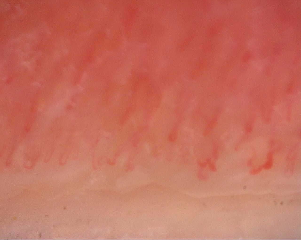 Nailfold capillaroscopy: right middle finger, field a. Initial study. Mixed Connective Tissue Disease Presenting with Raynaud Phenomenon.