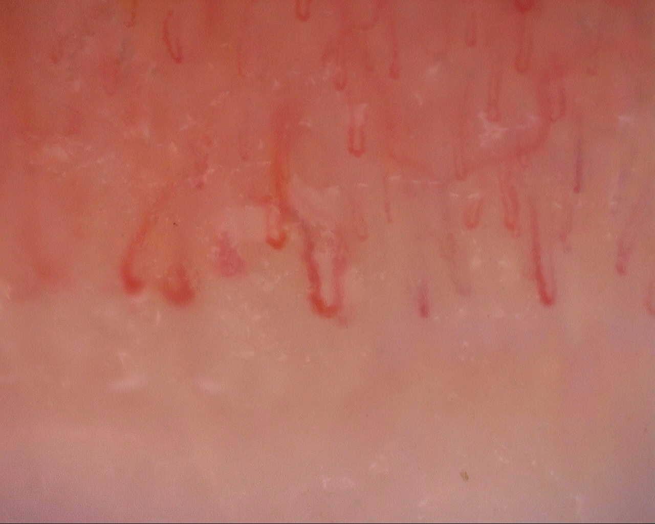 Nailfold capillaroscopy: right ring finger, field c. Initial study. Mixed Connective Tissue Disease Presenting with Raynaud Phenomenon.