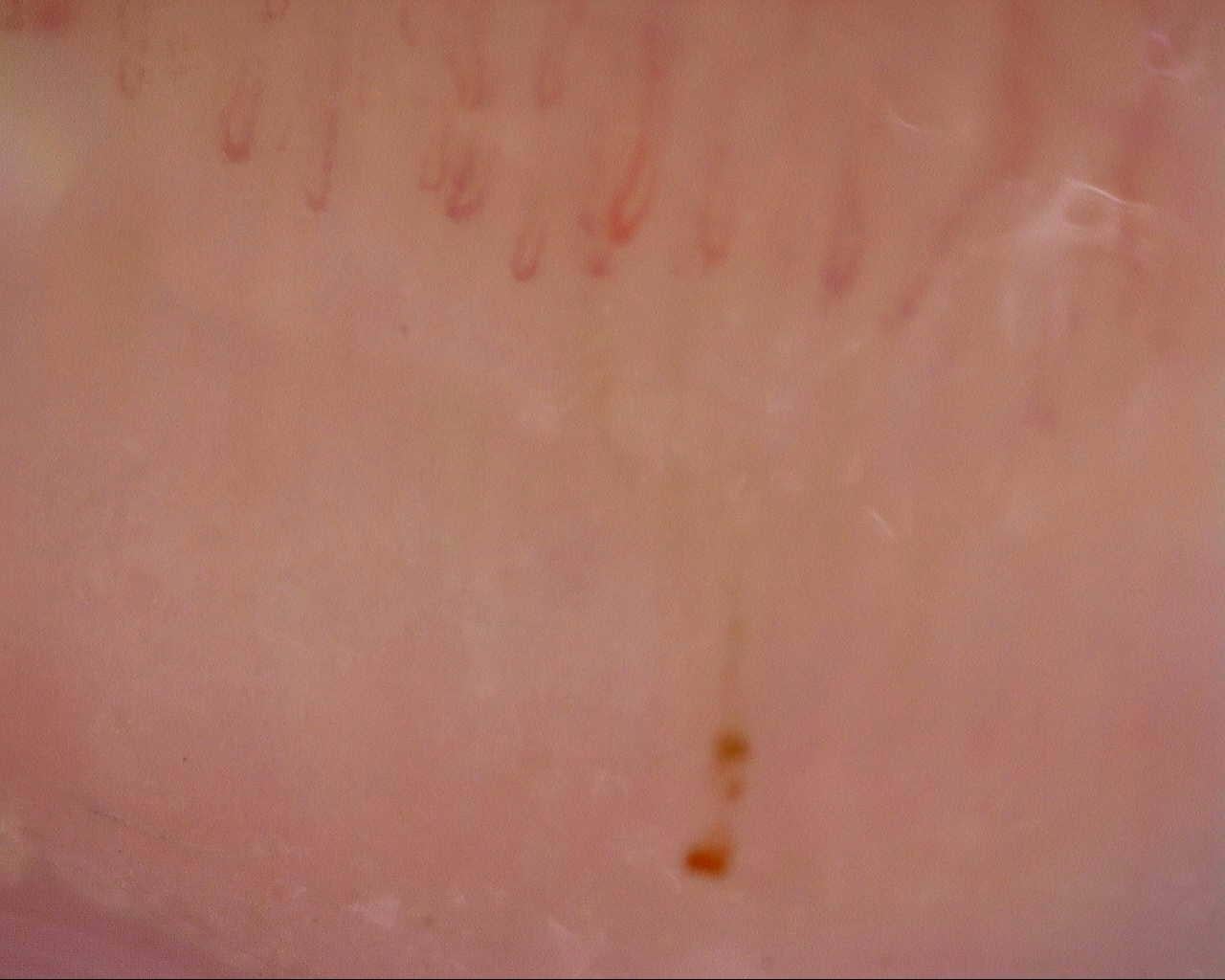 Nailfold capillaroscopy: left ring finger, field a. Initial study. Mixed Connective Tissue Disease Presenting with Raynaud Phenomenon.