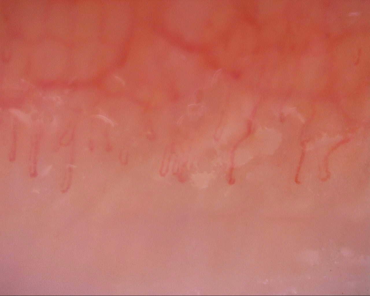 Nailfold capillaroscopy: right little finger, field b. Initial study. Mixed Connective Tissue Disease Presenting with Raynaud Phenomenon.