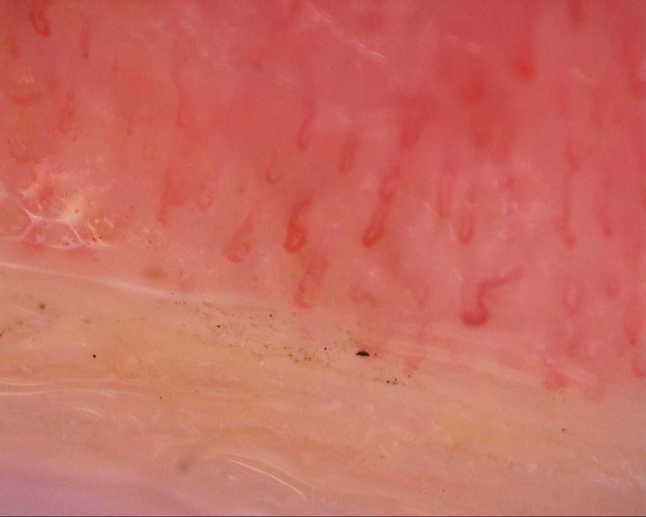 Nailfold capillaroscopy: right index finger, field d. Initial study. Mixed Connective Tissue Disease Presenting with Raynaud Phenomenon.