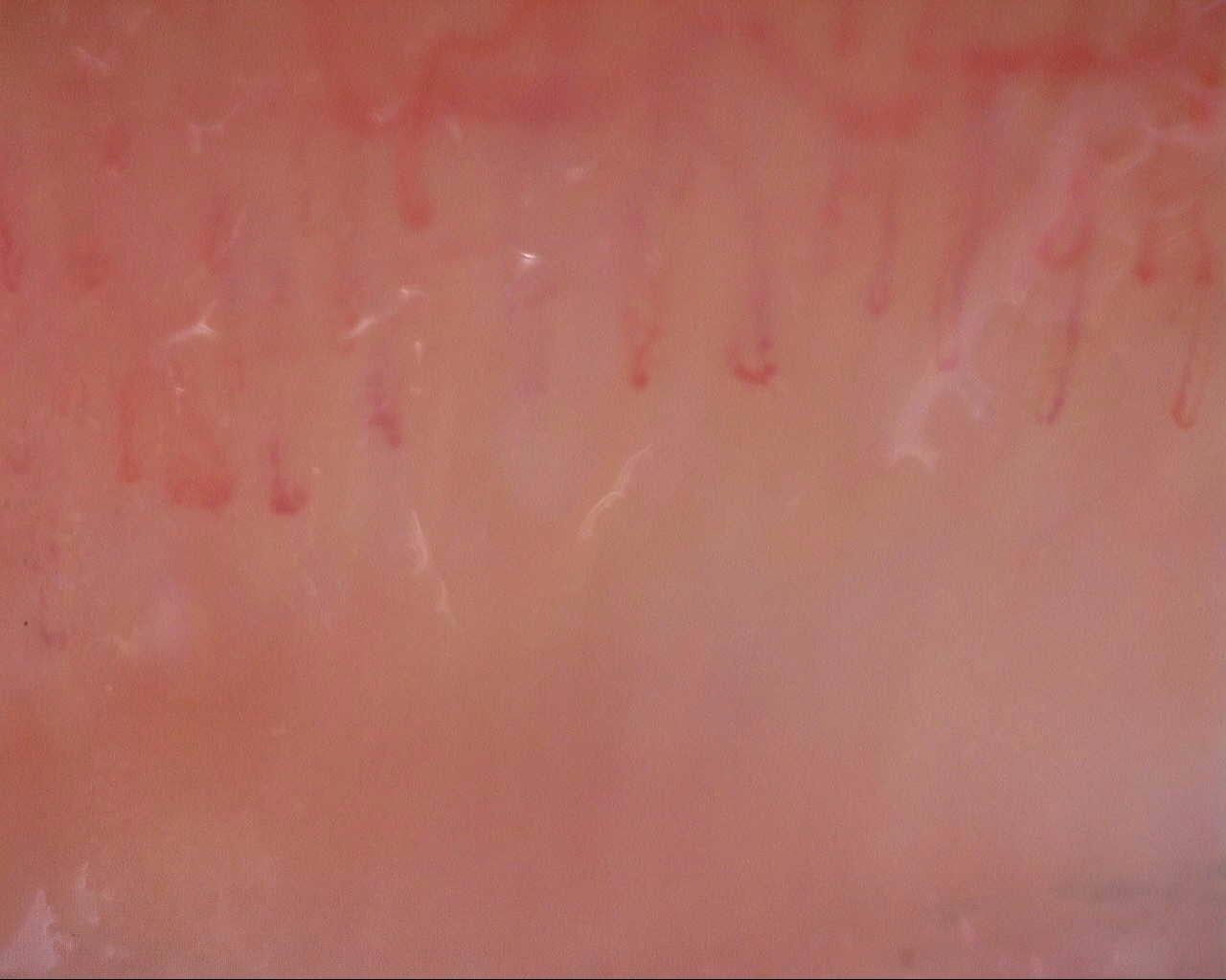 Nailfold capillaroscopy: right little finger, field a. Initial study. Mixed Connective Tissue Disease Presenting with Raynaud Phenomenon.