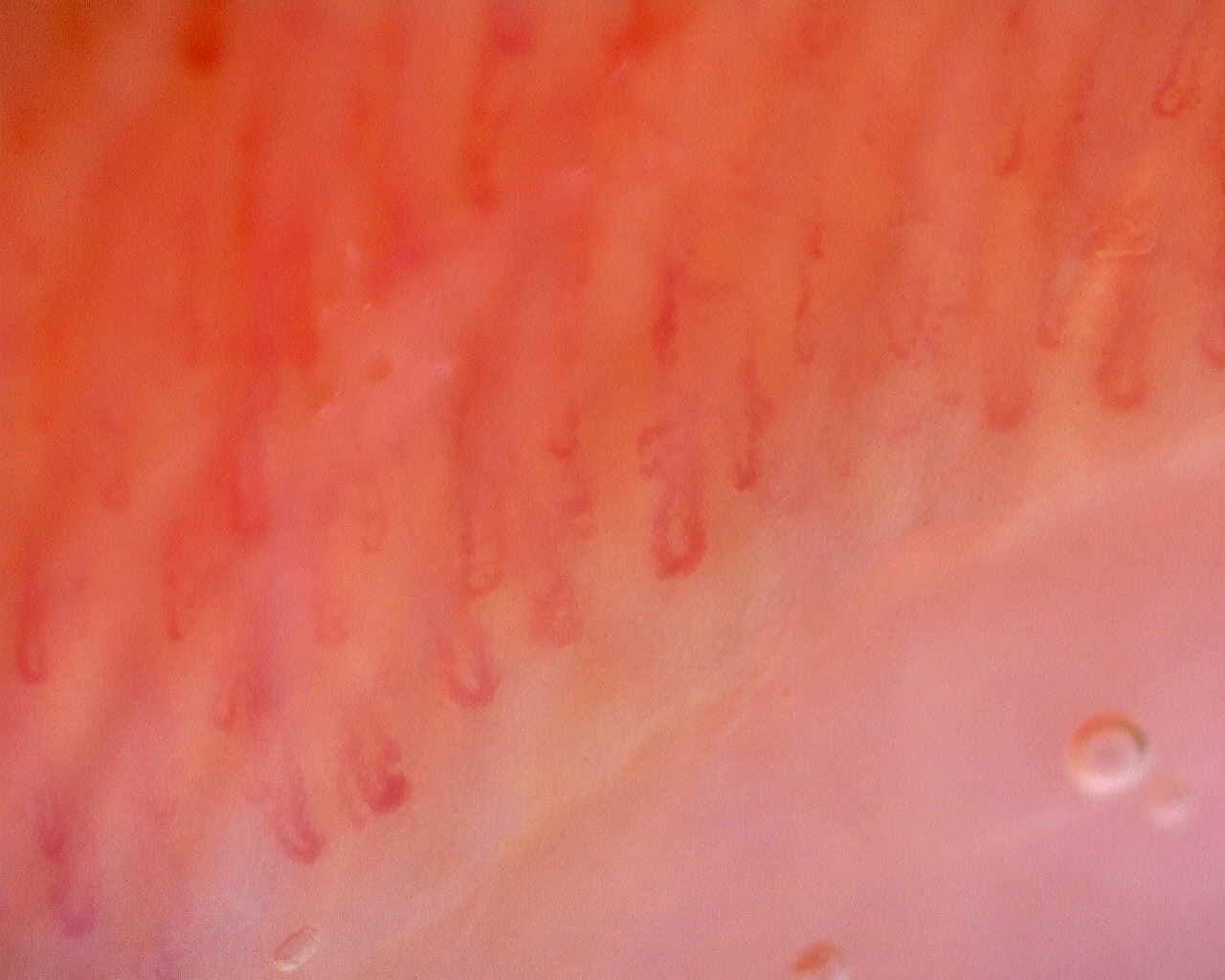 Nailfold capillaroscopy: left little finger, field a. Limited Cutaneous Systemic Sclerosis (ACA+) with Active Cutolo Pattern.