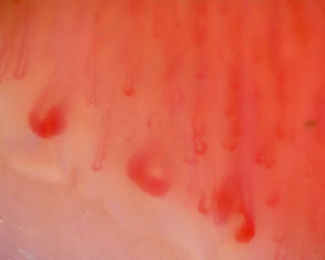 Nailfold capillaroscopy: right little finger, field a. Limited Cutaneous Systemic Sclerosis (ACA+) with Active Cutolo Pattern.