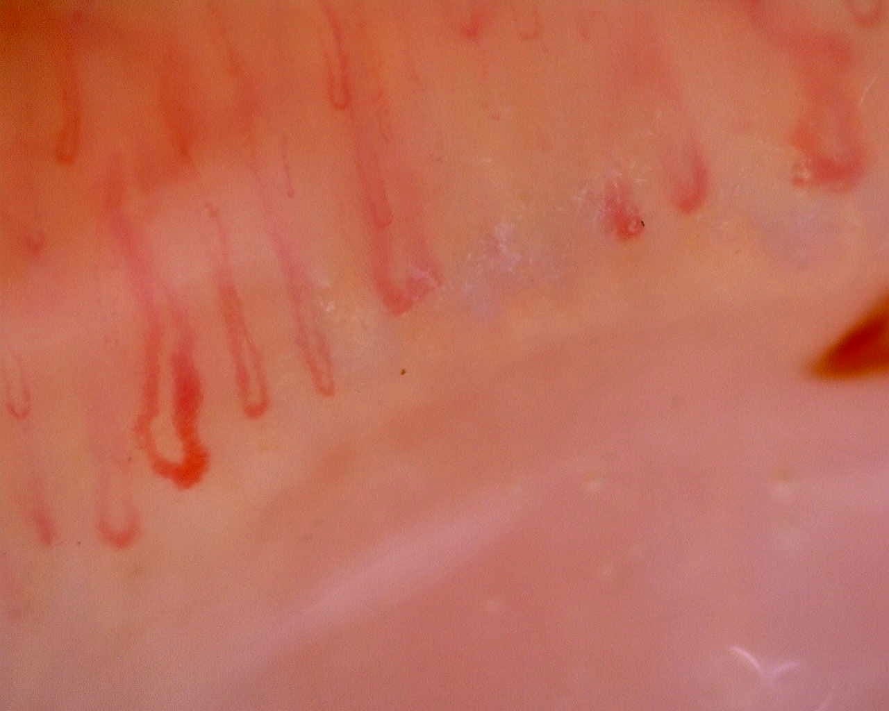 Nailfold capillaroscopy: left ring finger, field a. Limited Cutaneous Systemic Sclerosis (ACA+) with Active Cutolo Pattern.