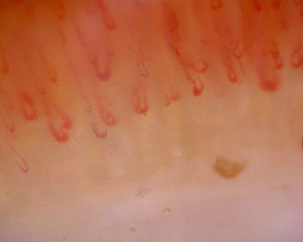 Nailfold capillaroscopy: right index finger, field c. Limited Cutaneous Systemic Sclerosis (ACA+) with Active Cutolo Pattern.