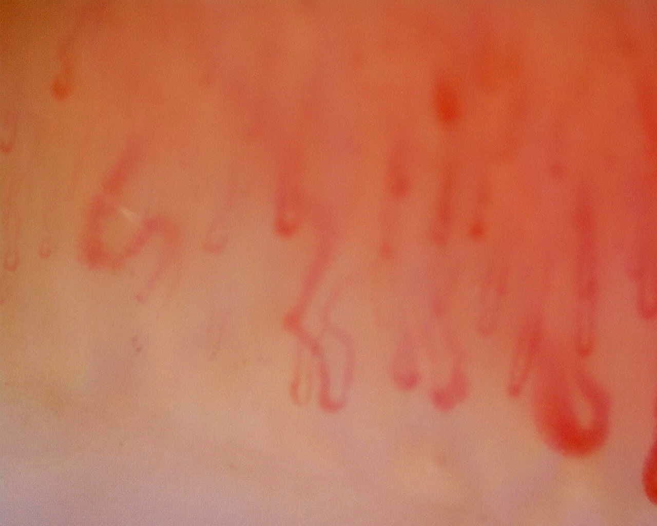 Nailfold capillaroscopy: left middle finger, field d. Limited Cutaneous Systemic Sclerosis (ACA+) with Active Cutolo Pattern.