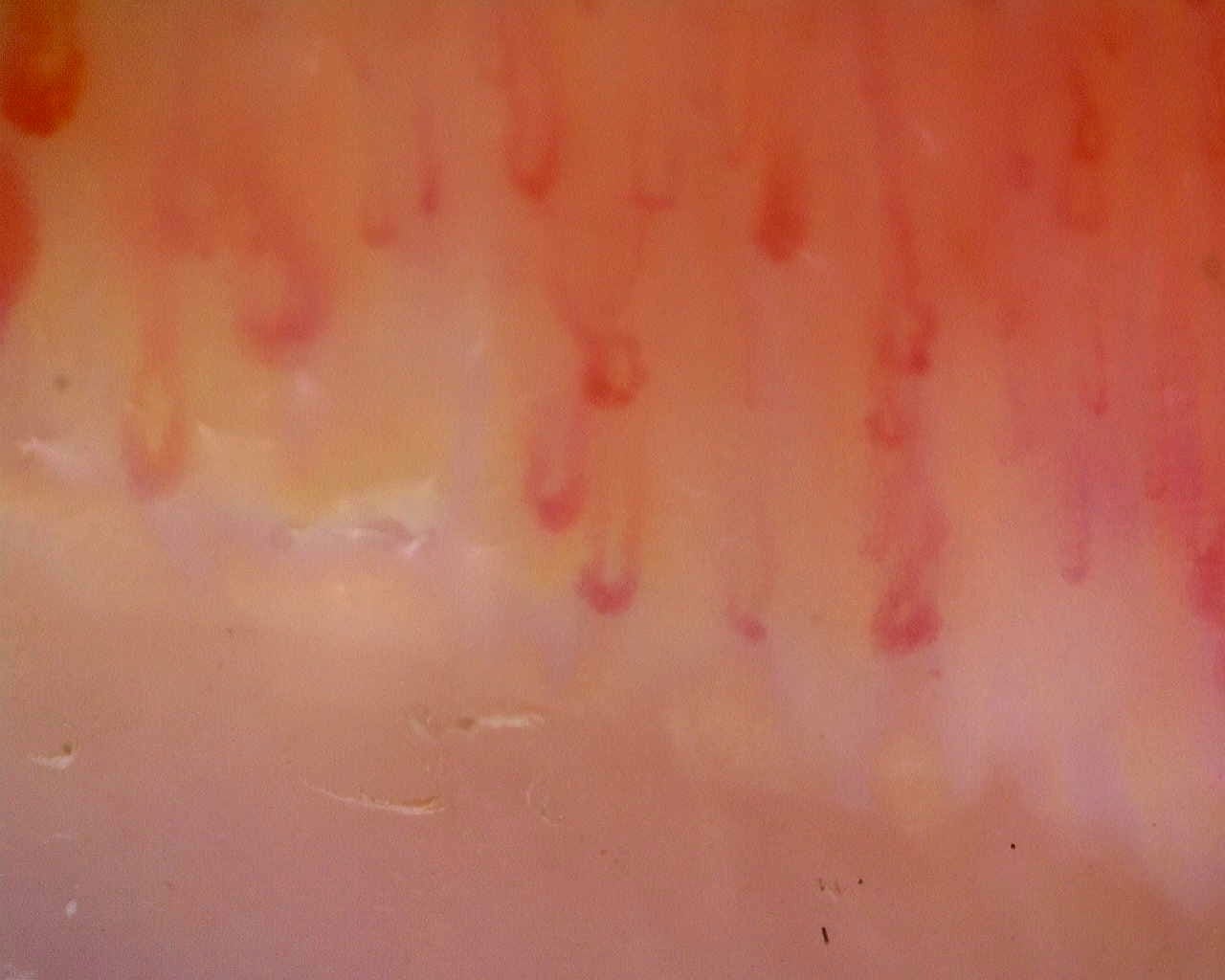 Nailfold capillaroscopy: right ring finger, field a. Limited Cutaneous Systemic Sclerosis (ACA+) with Active Cutolo Pattern.