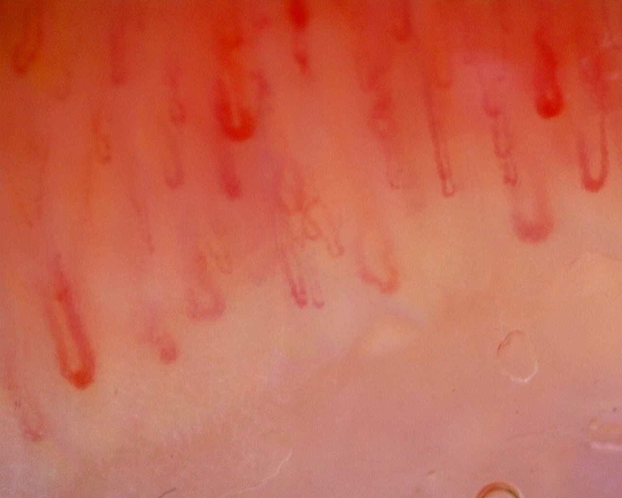 Nailfold capillaroscopy: left index finger, field a. Limited Cutaneous Systemic Sclerosis (ACA+) with Active Cutolo Pattern.
