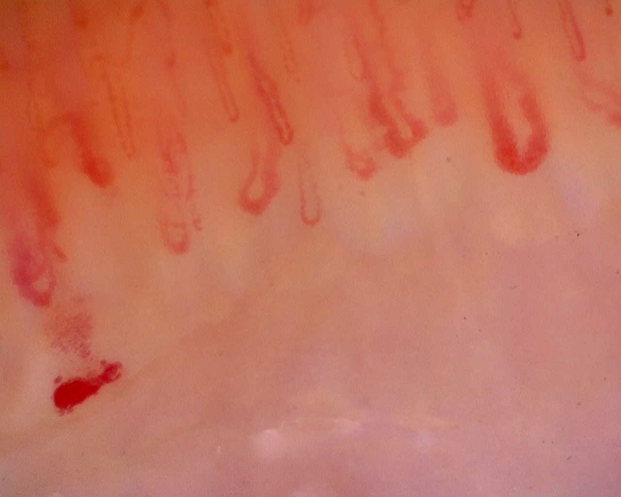 Nailfold capillaroscopy: right little finger, field d. Limited Cutaneous Systemic Sclerosis (ACA+) with Active Cutolo Pattern.