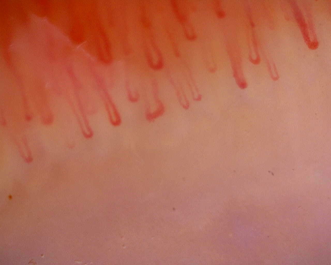 Nailfold capillaroscopy: left middle finger, field a. Limited Cutaneous Systemic Sclerosis (ACA+) with Active Cutolo Pattern.
