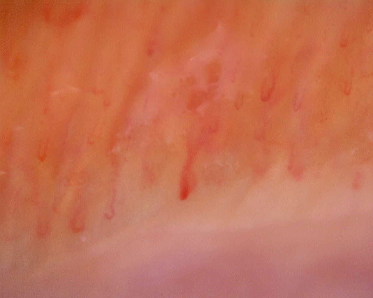 Nailfold capillaroscopy: left little finger, field b. Limited Cutaneous Systemic Sclerosis (ACA+) with Active Cutolo Pattern.