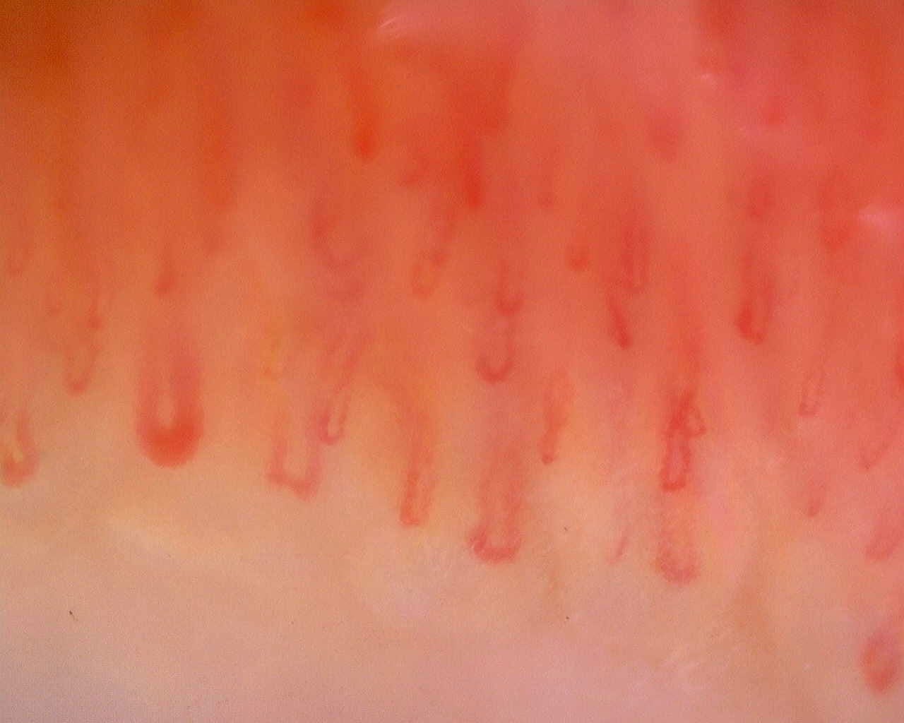 Nailfold capillaroscopy: right index finger, field a. Limited Cutaneous Systemic Sclerosis (ACA+) with Active Cutolo Pattern.