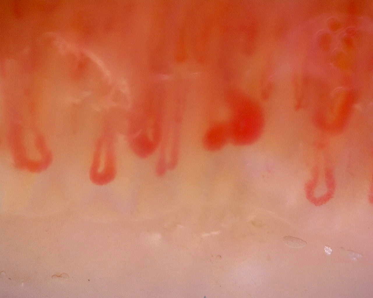 Nailfold capillaroscopy: left index finger, field c. Limited Cutaneous Systemic Sclerosis (ACA+) with Active Cutolo Pattern.