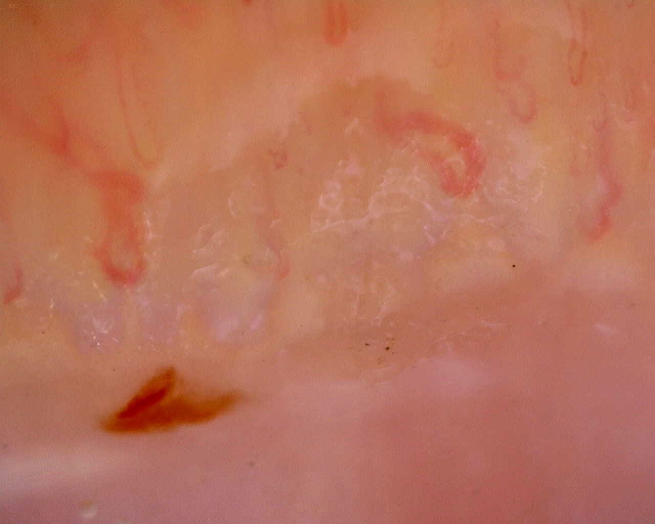 Nailfold capillaroscopy: left ring finger, field b. Limited Cutaneous Systemic Sclerosis (ACA+) with Active Cutolo Pattern.