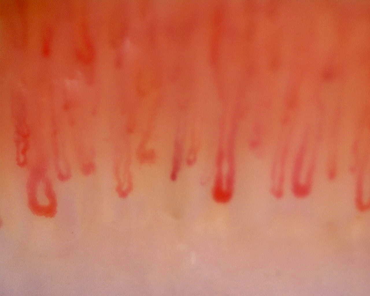 Nailfold capillaroscopy: left middle finger, field c. Limited Cutaneous Systemic Sclerosis (ACA+) with Active Cutolo Pattern.