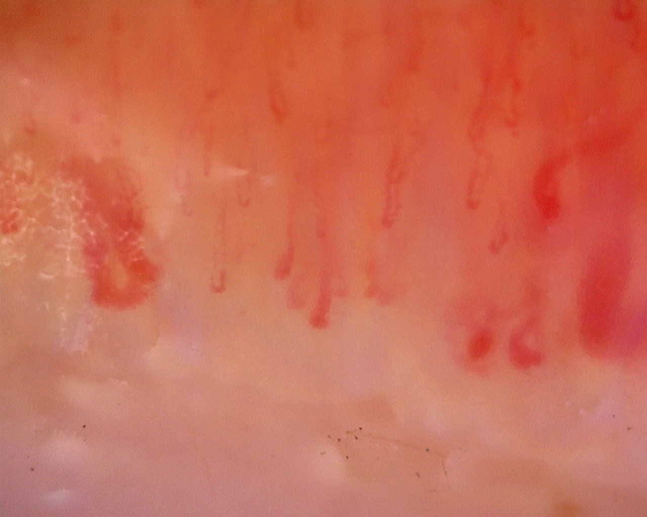 Nailfold capillaroscopy: left ring finger, field c. Limited Cutaneous Systemic Sclerosis (ACA+) with Active Cutolo Pattern.