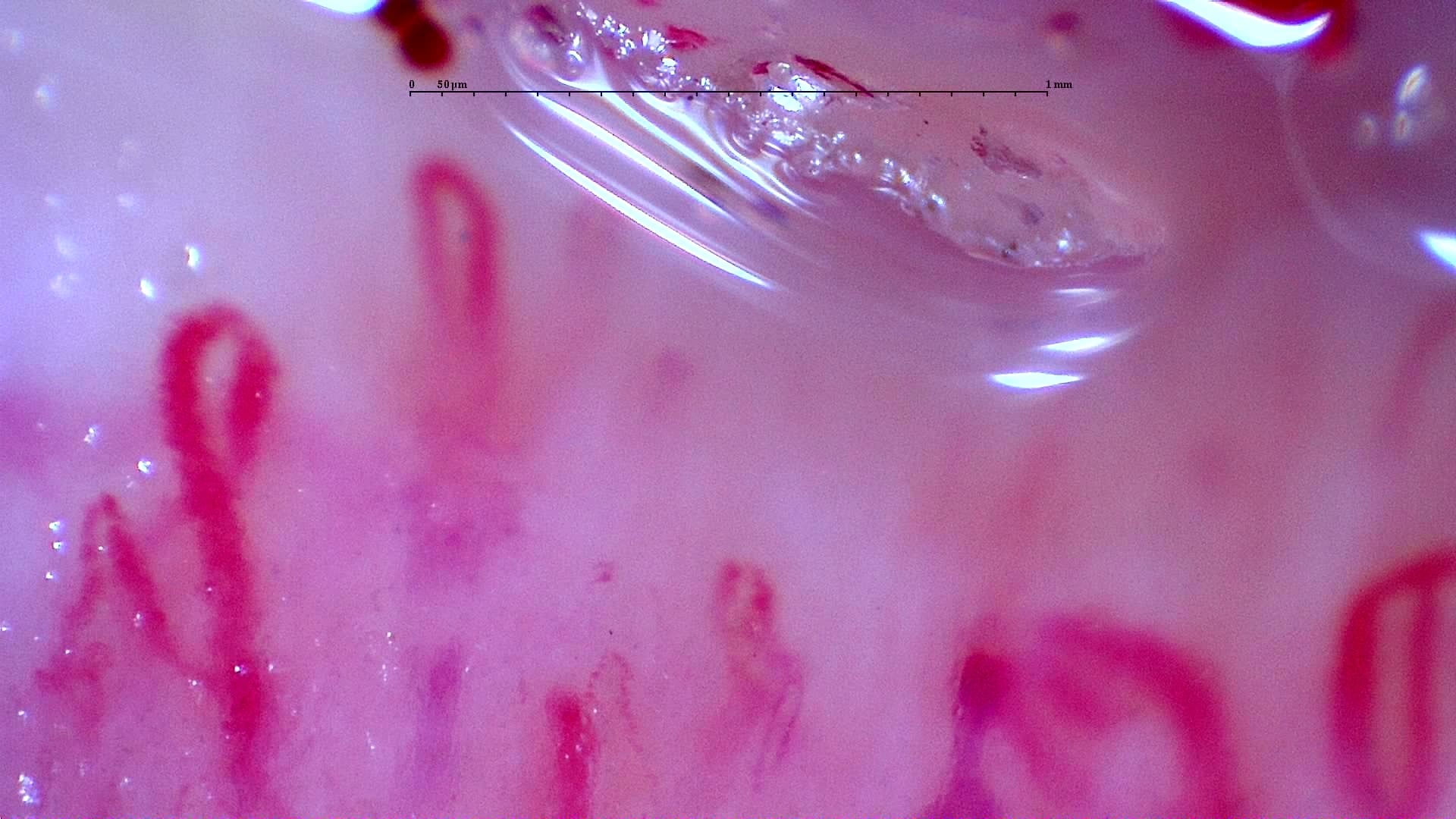 Nailfold capillaroscopy: left ring finger, field b. Initial study. Anti-NXP2 Dermatomyositis with Capillaroscopic Improvement.