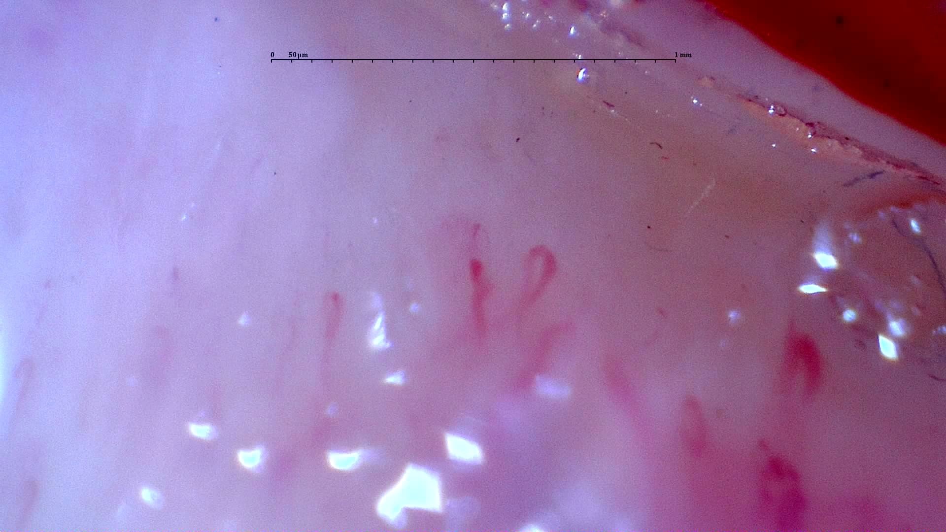 Nailfold capillaroscopy: right middle finger, field a. Initial study. Anti-NXP2 Dermatomyositis with Capillaroscopic Improvement.