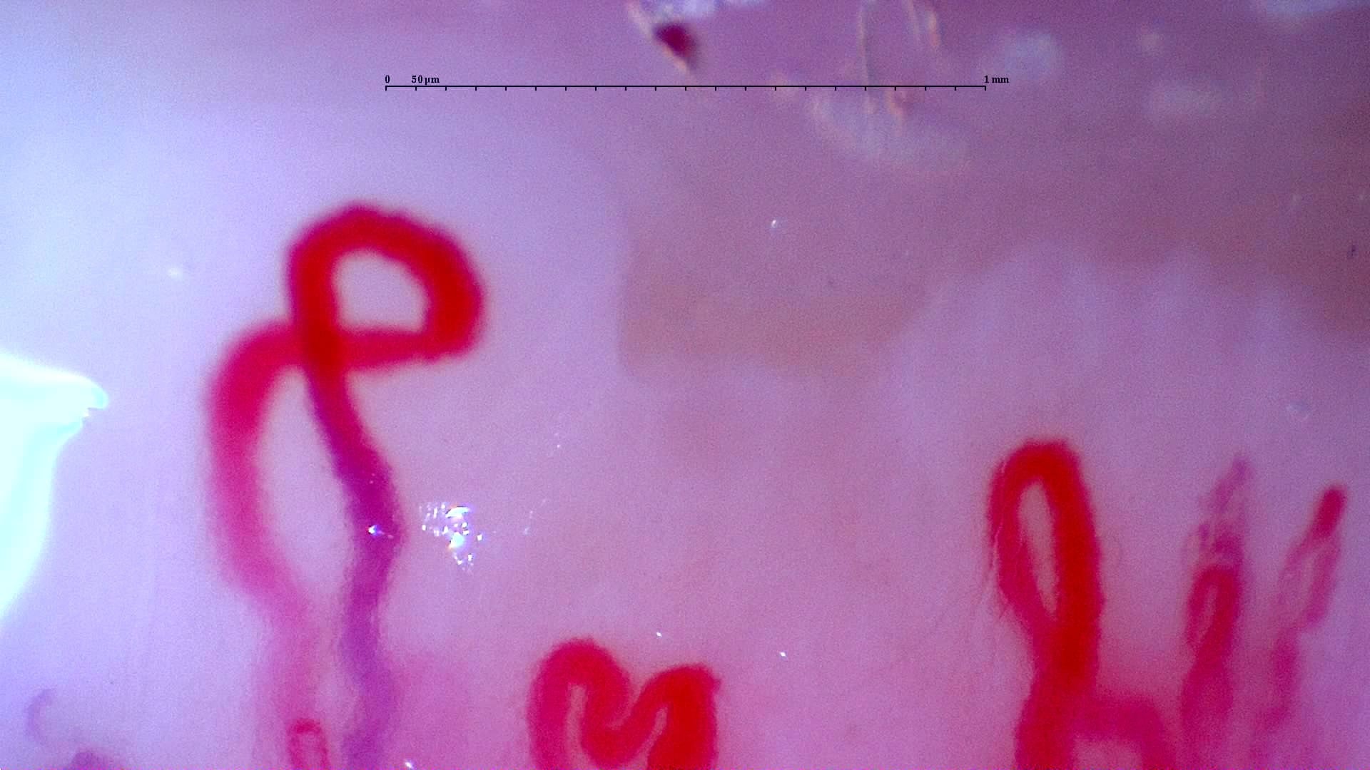 Nailfold capillaroscopy: left middle finger, field b. Initial study. Anti-NXP2 Dermatomyositis with Capillaroscopic Improvement.