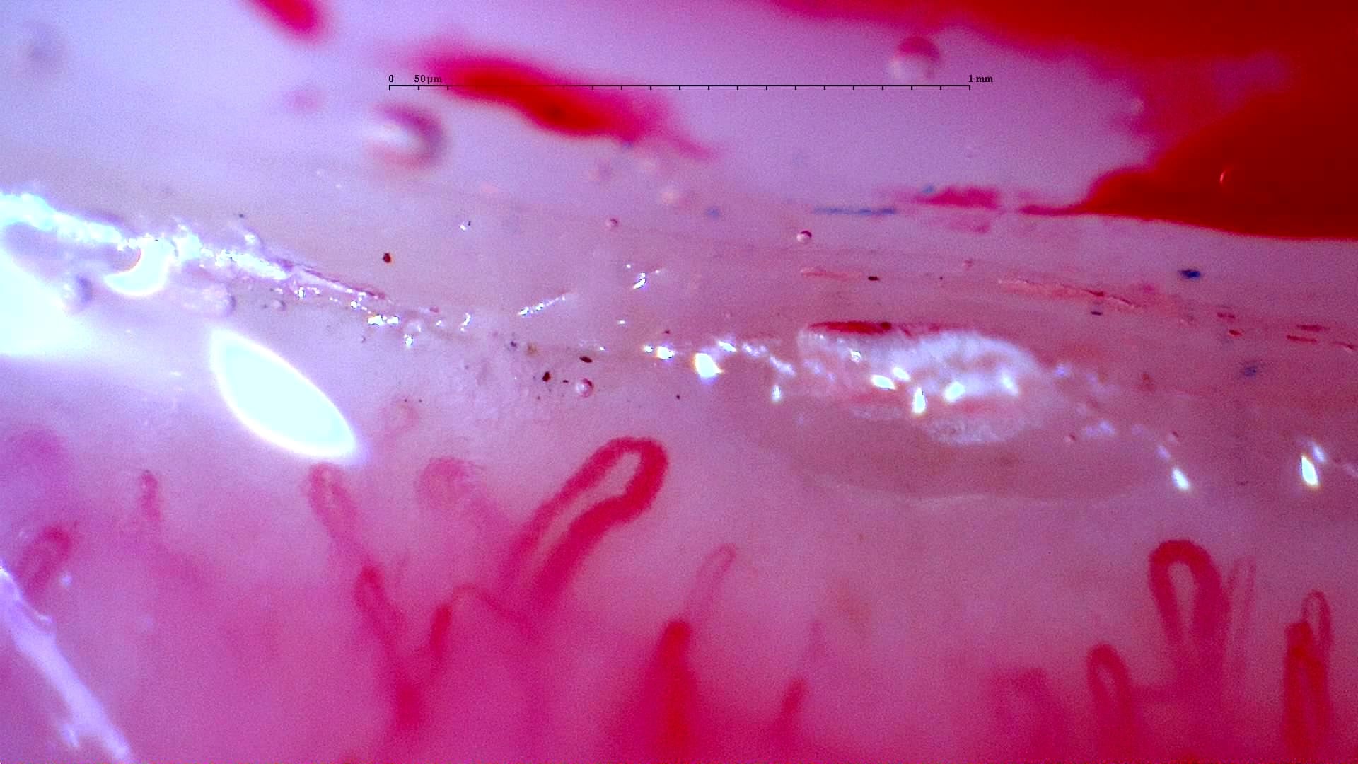 Nailfold capillaroscopy: right index finger, field c. Initial study. Anti-NXP2 Dermatomyositis with Capillaroscopic Improvement.