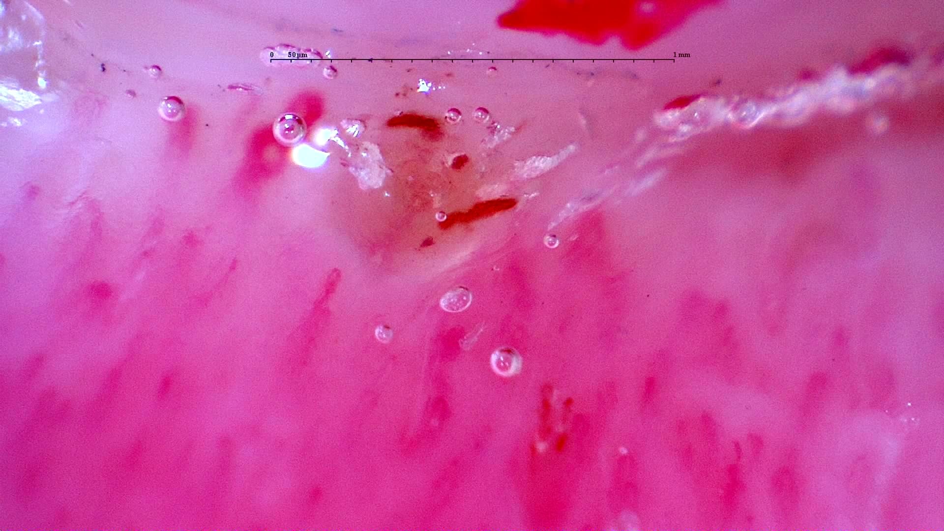 Nailfold capillaroscopy: right little finger, field c. Initial study. Anti-NXP2 Dermatomyositis with Capillaroscopic Improvement.