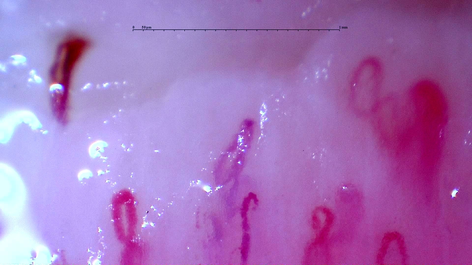 Nailfold capillaroscopy: left middle finger, field a. Initial study. Anti-NXP2 Dermatomyositis with Capillaroscopic Improvement.