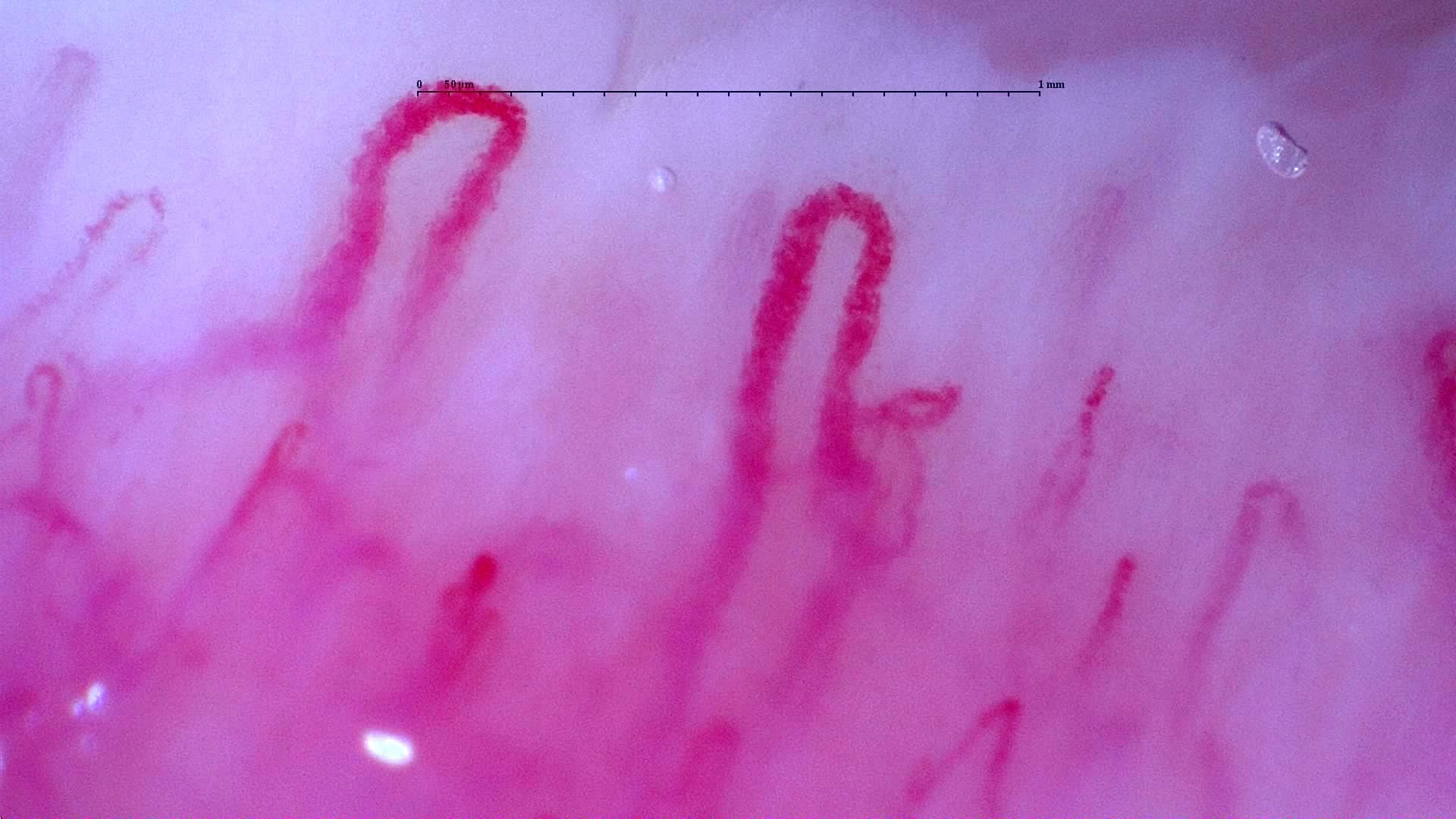 Nailfold capillaroscopy: left index finger, field b. Initial study. Anti-NXP2 Dermatomyositis with Capillaroscopic Improvement.