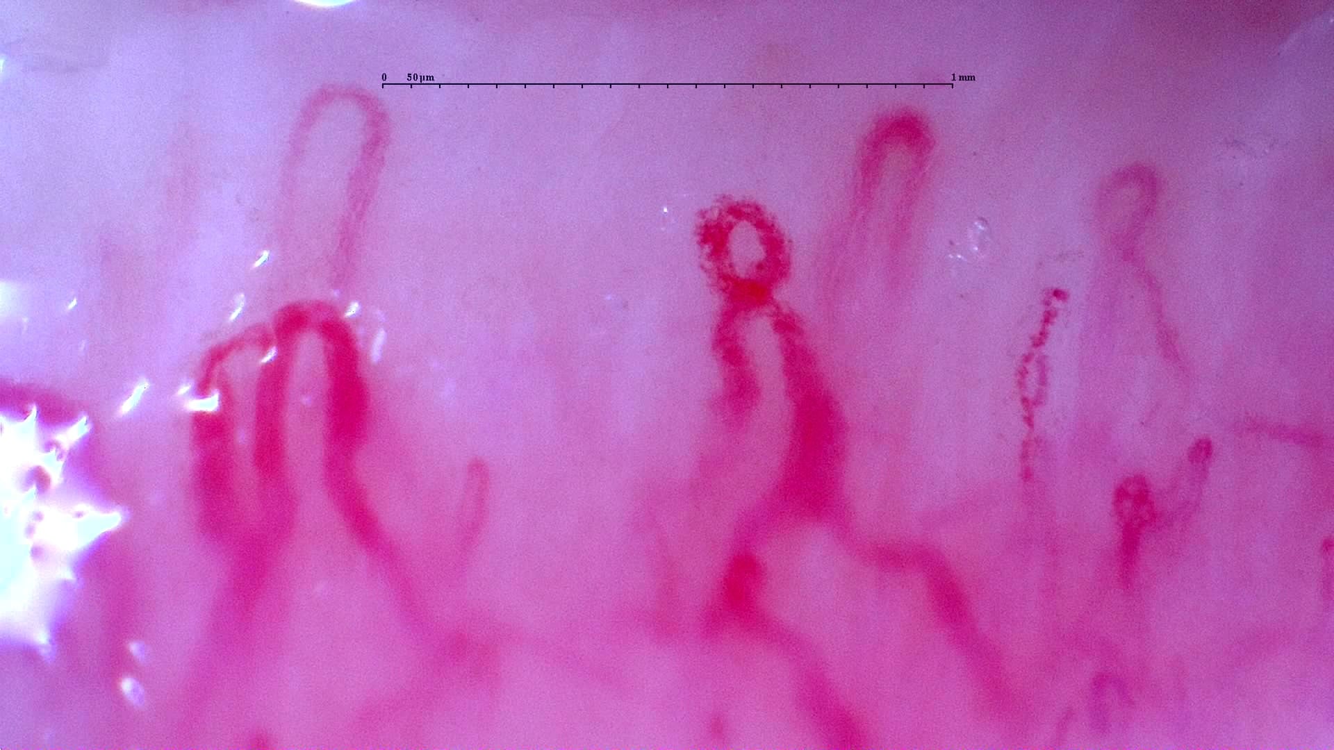 Nailfold capillaroscopy: left ring finger, field a. Initial study. Anti-NXP2 Dermatomyositis with Capillaroscopic Improvement.