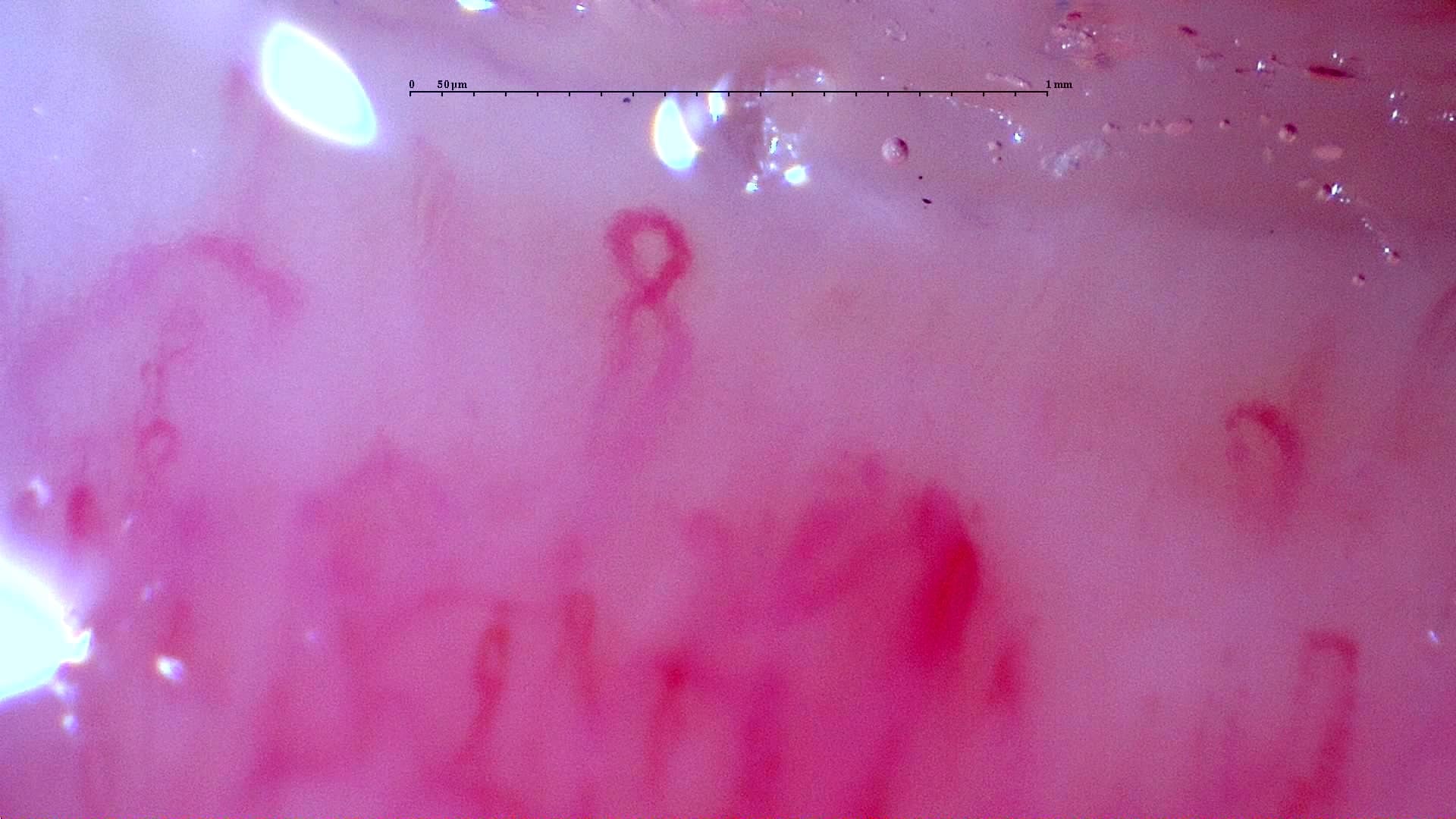 Nailfold capillaroscopy: right middle finger, field b. Initial study. Anti-NXP2 Dermatomyositis with Capillaroscopic Improvement.