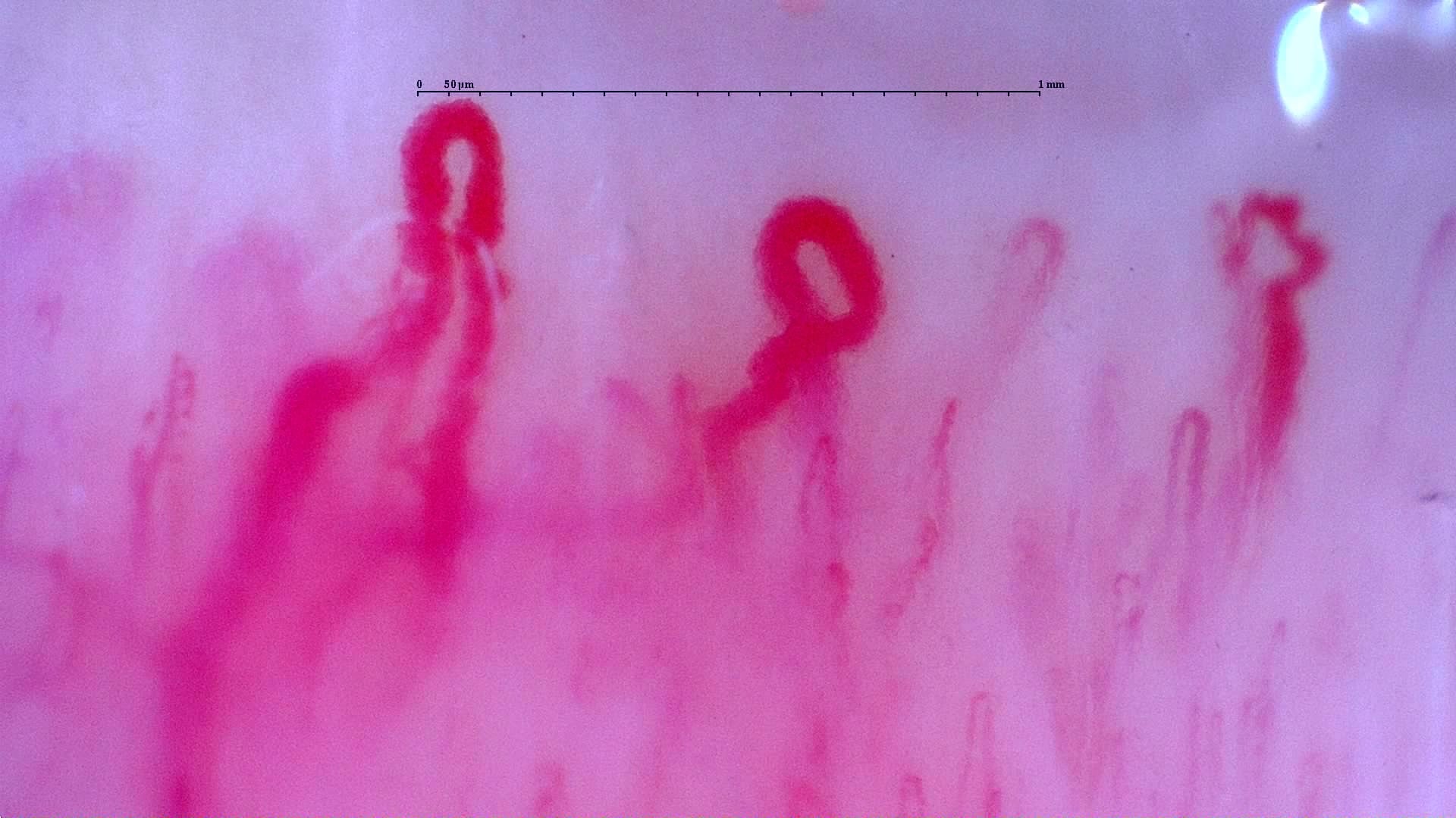 Nailfold capillaroscopy: right ring finger, field d. Initial study. Anti-NXP2 Dermatomyositis with Capillaroscopic Improvement.