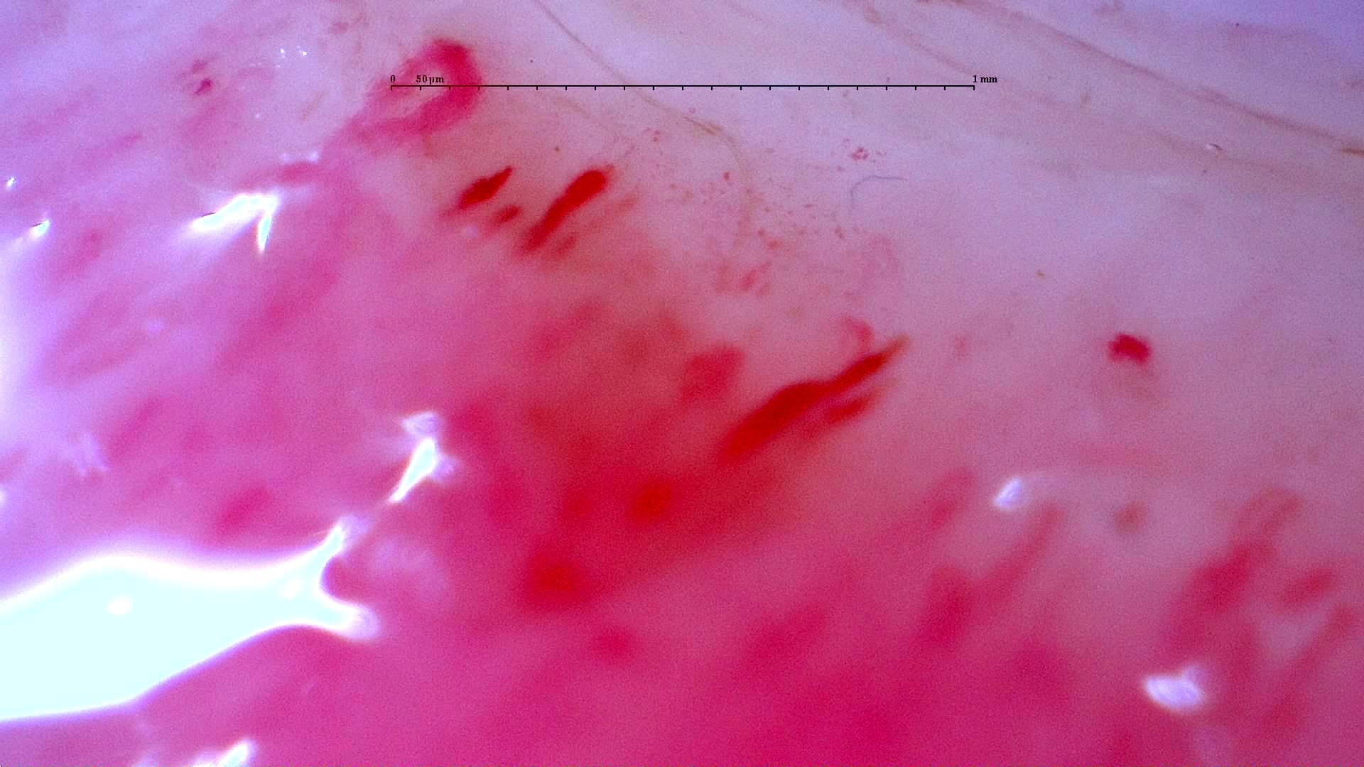 Nailfold capillaroscopy: left little finger, field c. Initial study. Anti-NXP2 Dermatomyositis with Capillaroscopic Improvement.