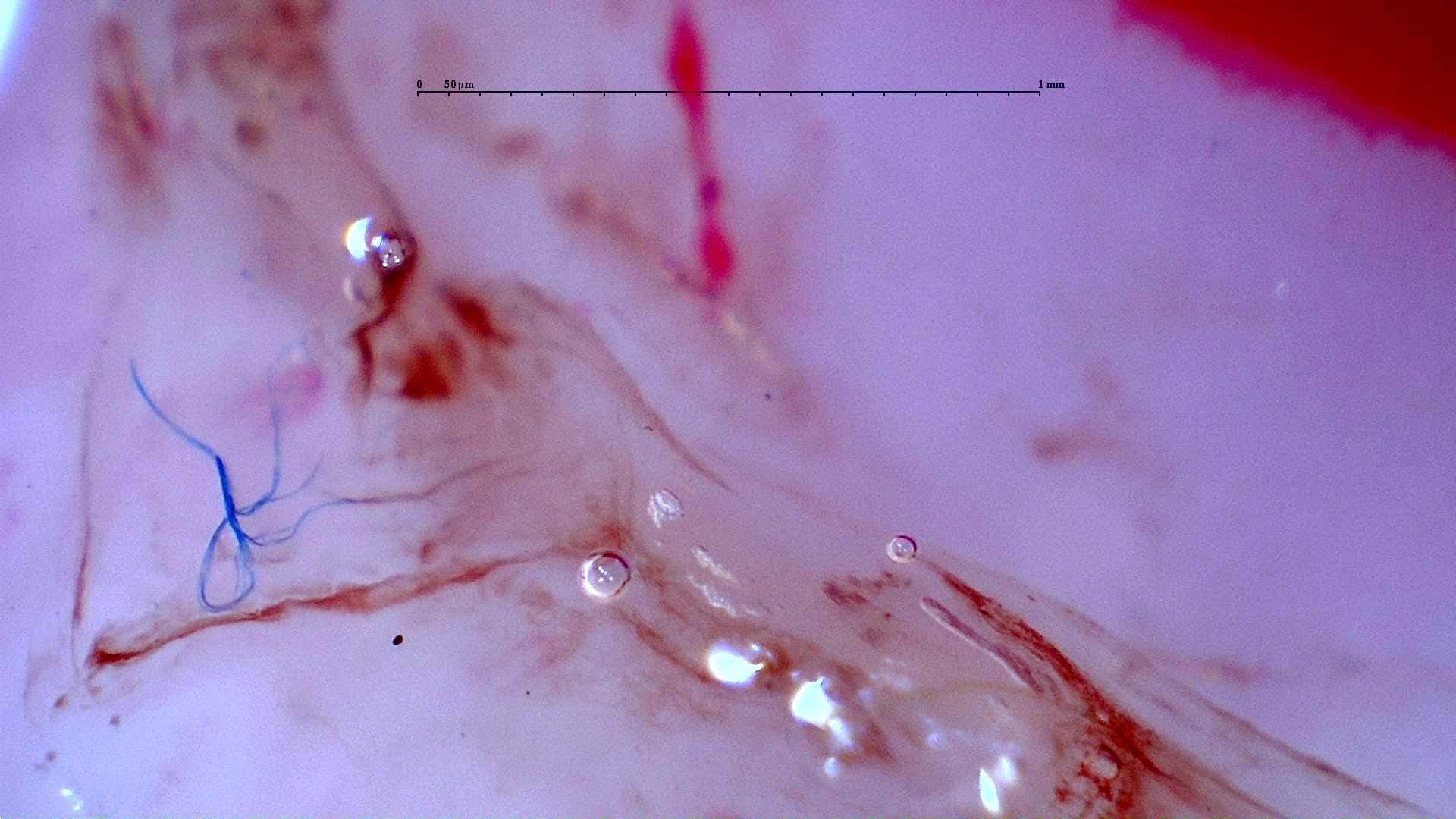 Nailfold capillaroscopy: left little finger, field d. Initial study. Anti-NXP2 Dermatomyositis with Capillaroscopic Improvement.