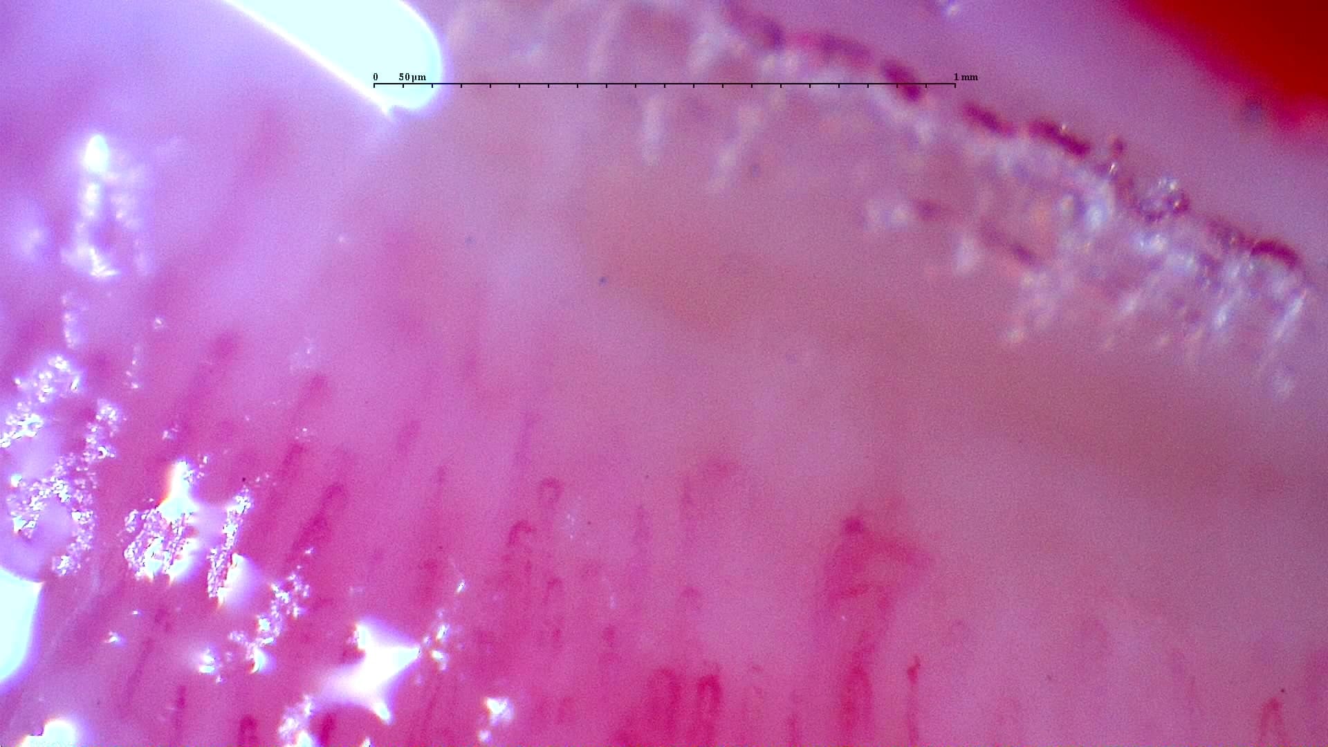 Nailfold capillaroscopy: right little finger, field a. Initial study. Anti-NXP2 Dermatomyositis with Capillaroscopic Improvement.
