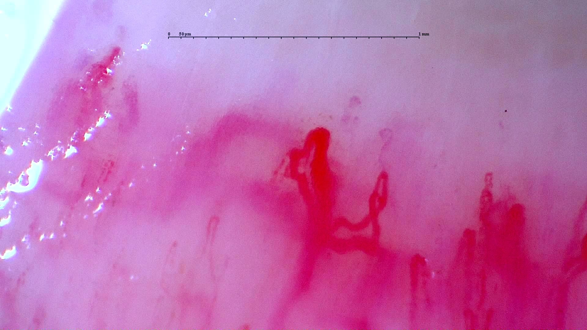 Nailfold capillaroscopy: left middle finger, field c. Initial study. Anti-NXP2 Dermatomyositis with Capillaroscopic Improvement.