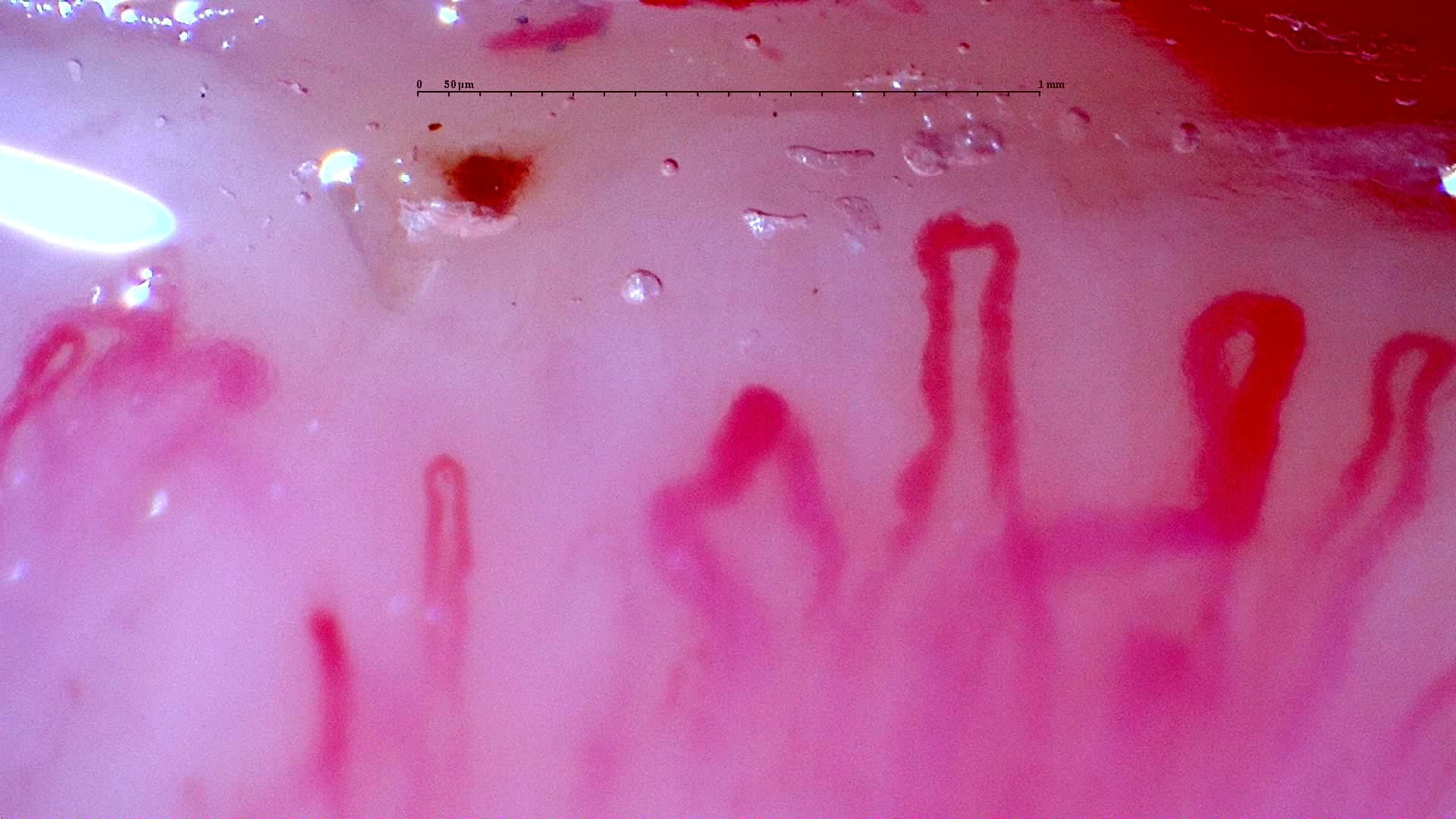 Nailfold capillaroscopy: right middle finger, field c. Initial study. Anti-NXP2 Dermatomyositis with Capillaroscopic Improvement.