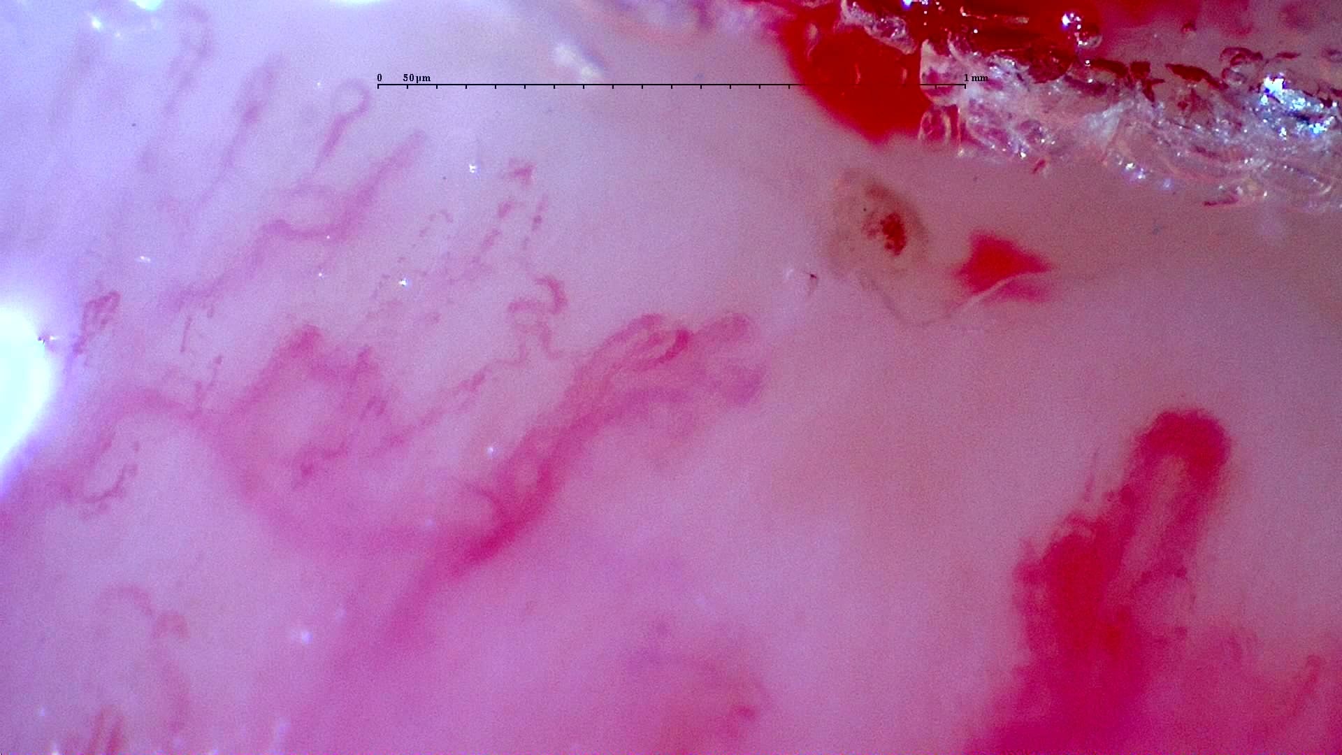 Nailfold capillaroscopy: right ring finger, field b. Initial study. Anti-NXP2 Dermatomyositis with Capillaroscopic Improvement.