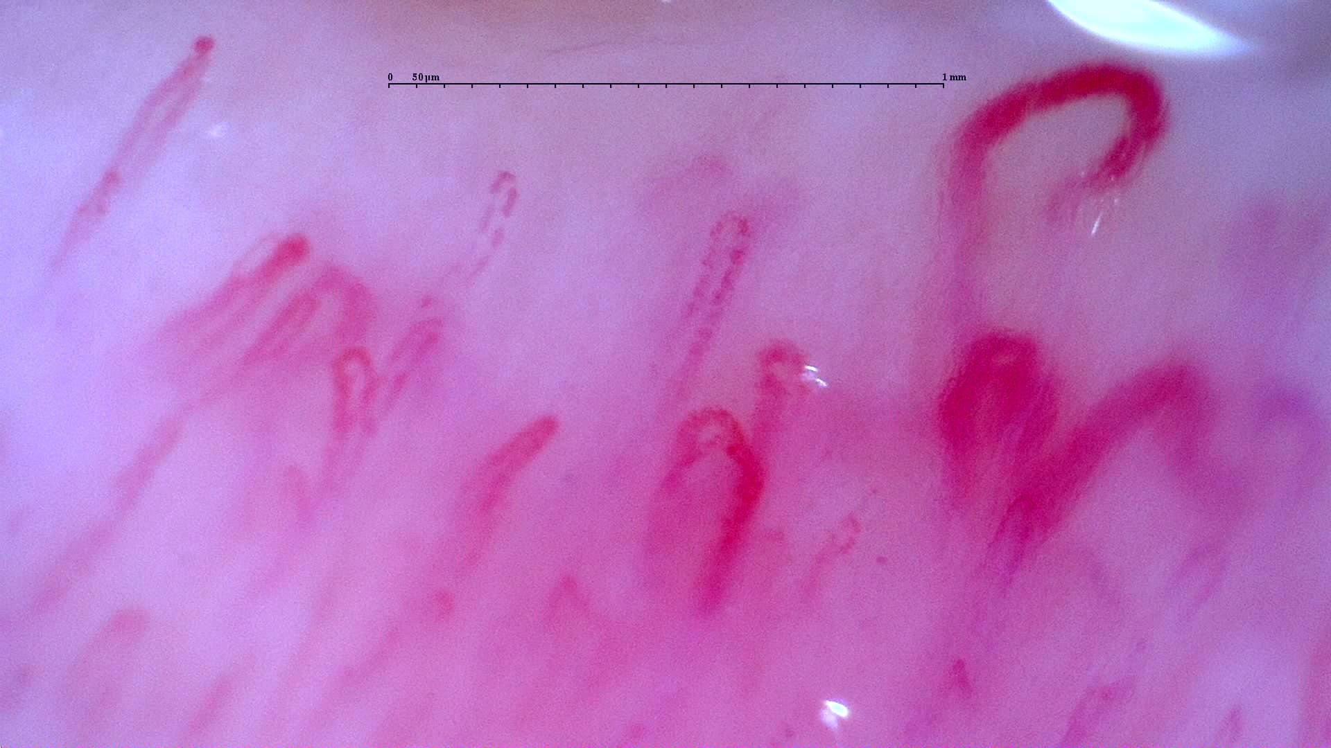 Nailfold capillaroscopy: right middle finger, field d. Initial study. Anti-NXP2 Dermatomyositis with Capillaroscopic Improvement.