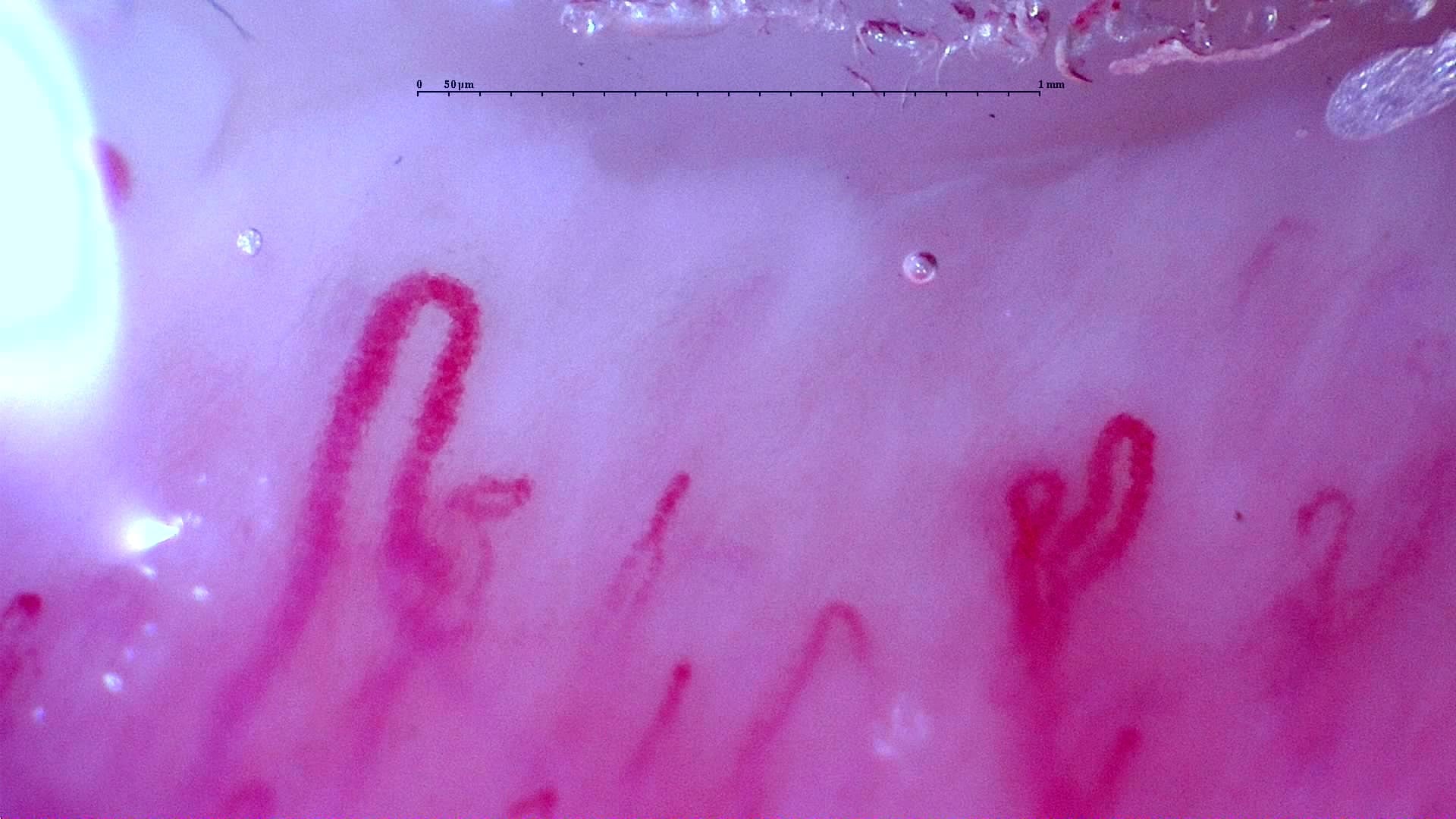 Nailfold capillaroscopy: left index finger, field c. Initial study. Anti-NXP2 Dermatomyositis with Capillaroscopic Improvement.