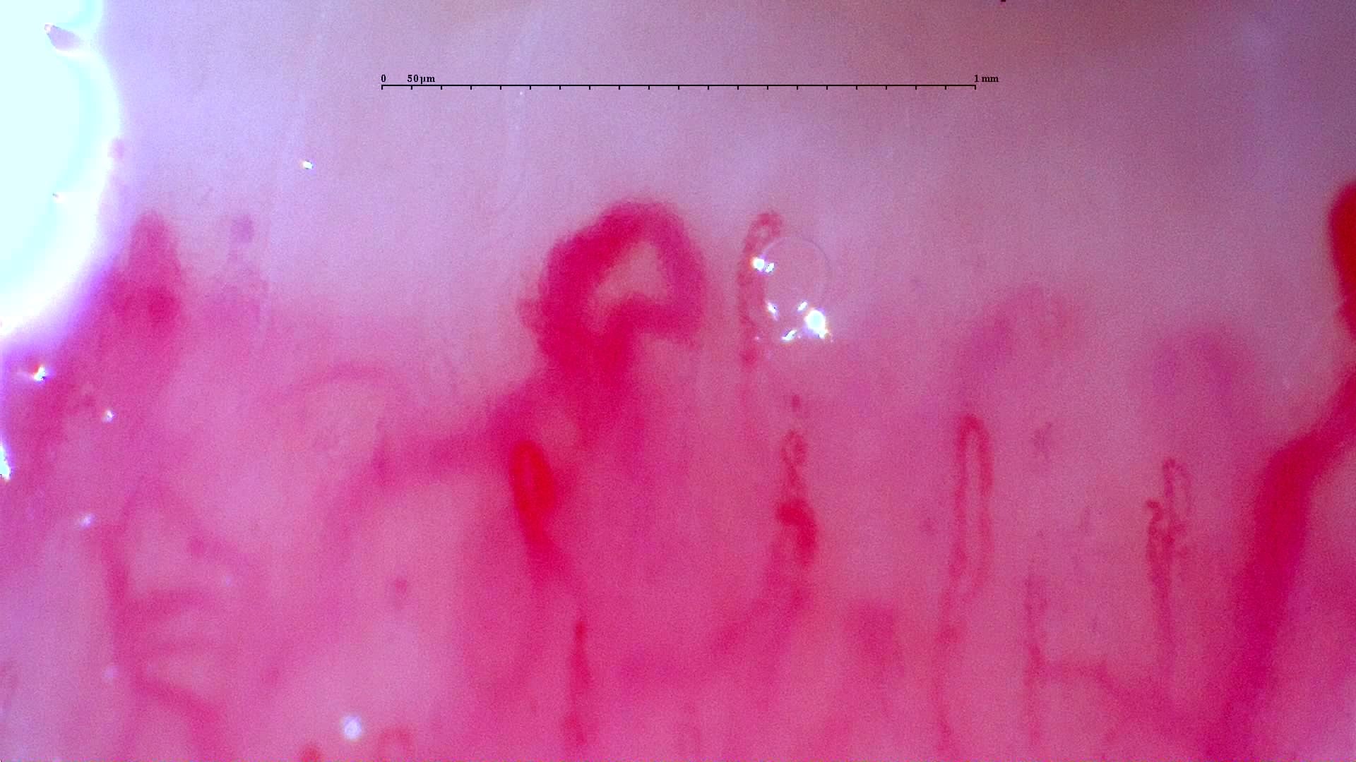 Nailfold capillaroscopy: right ring finger, field c. Initial study. Anti-NXP2 Dermatomyositis with Capillaroscopic Improvement.