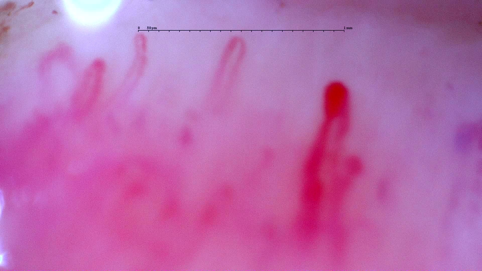 Nailfold capillaroscopy: left little finger, field a. Initial study. Anti-NXP2 Dermatomyositis with Capillaroscopic Improvement.