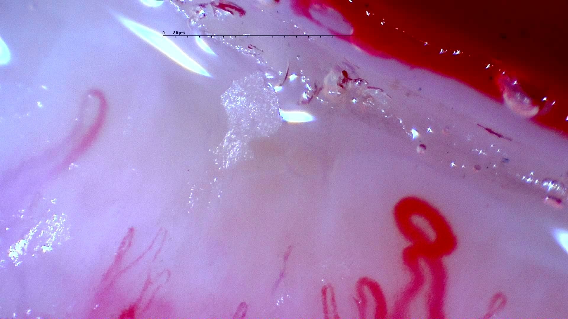 Nailfold capillaroscopy: left ring finger, field d. Initial study. Anti-NXP2 Dermatomyositis with Capillaroscopic Improvement.