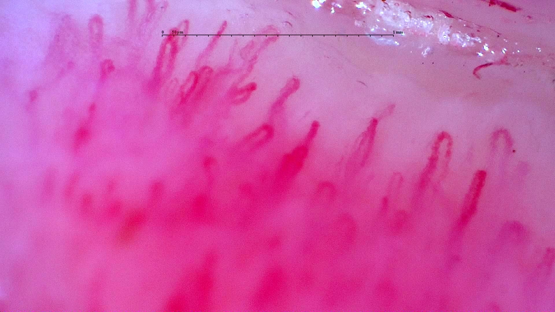 Nailfold capillaroscopy: right index finger, field d. Initial study. Anti-NXP2 Dermatomyositis with Capillaroscopic Improvement.